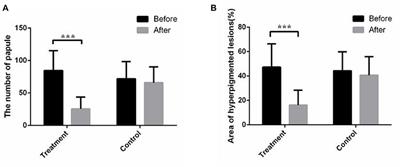 Efficacy of a New Non-drug Acne Therapy: Aloe Vera Gel Combined With Ultrasound and Soft Mask for the Treatment of Mild to Severe Facial Acne